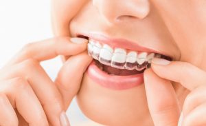6 Tips To Get The Most From An Invisalign Treatment